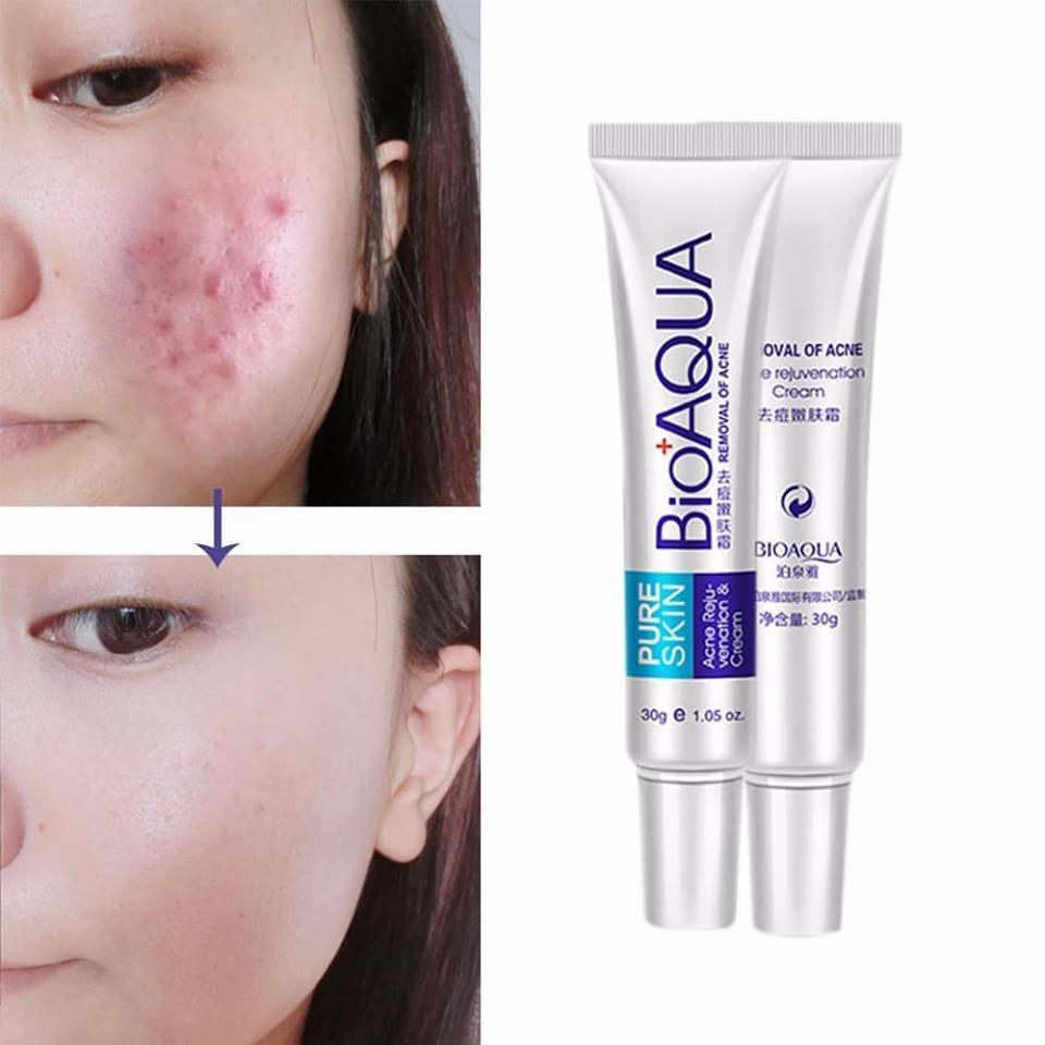 Bioaqua Pure Skin Acne Removal and Rejuvenation Cream -25 gm cloud shopbd